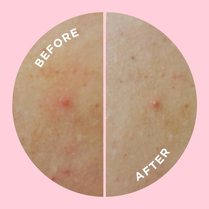 ZitSticka Pimple Patches for Face and Body, Goo Getter Hydrocolloid Patches to Cover Zits & Blemishes, Acne Patches or Zit Spot Stickers, Body Blemish Patch (Body Patch 9 Pack)