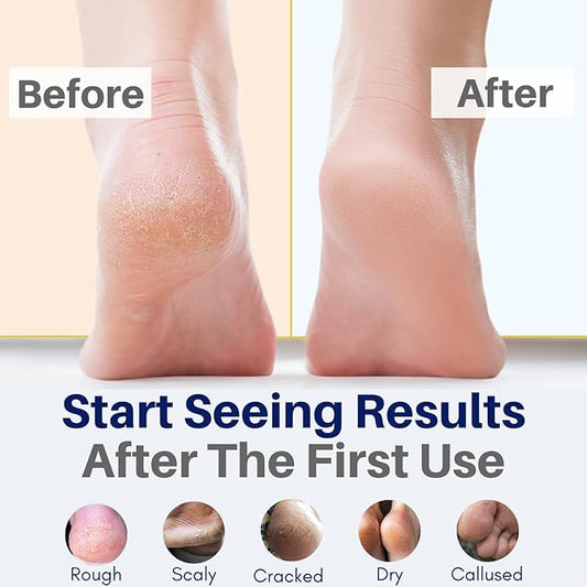 Yellow Bird Natural Tea Tree Foot Cream & Organic Foot Balm for Dry, Cracked Feet & Heels – Peppermint Moisturizer for Athlete’s Foot Relief and Intensive Callus Repair Treatment Salve – Made in USA