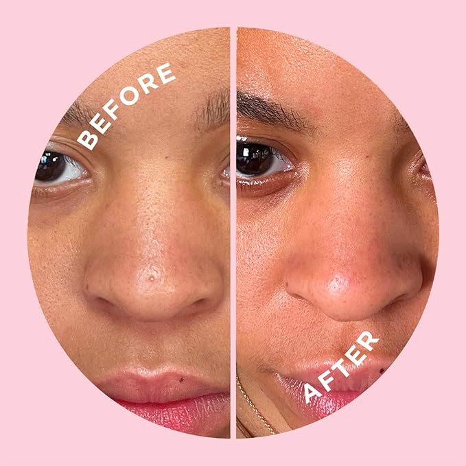 ZitSticka Pimple Patches for Face and Body, Goo Getter Hydrocolloid Patches to Cover Zits & Blemishes, Acne Patches or Zit Spot Stickers, Body Blemish Patch (Nose Strip Pack 8 Pack)